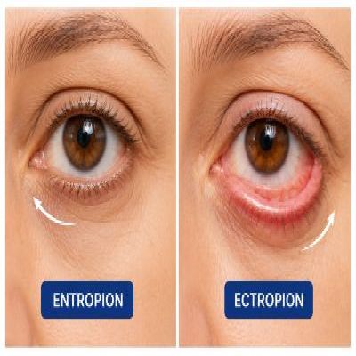 Eyelid Repair